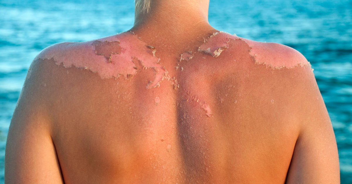 Sunburn or Sun Poisoning?